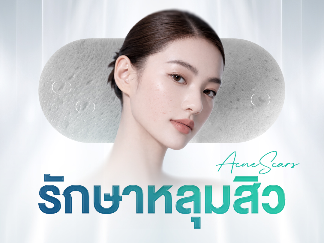 หลุมสิว